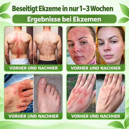 𝐌𝐎𝐏𝐑𝐎® 👩‍⚕️👩‍⚕️ 𝐈𝐋-𝟐𝟑𝐑-𝐀𝐧𝐭𝐚𝐠𝐨𝐧𝐢𝐬𝐭-𝐏𝐞𝐩𝐭𝐢𝐝 + 𝐈𝐧𝐝𝐢𝐫𝐮𝐛𝐢𝐧 𝟏𝟎-𝐈𝐍-𝟏 𝐍𝐚𝐧𝐨-𝐌𝐢𝐤𝐫𝐨𝐧𝐚𝐝𝐞𝐥-𝐏𝐟𝐥𝐚𝐬𝐭𝐞𝐫 (𝐇𝐢𝐥𝐟𝐭 𝐛𝐞𝐢 𝐑ö𝐭𝐮𝐧𝐠𝐞𝐧, 𝐒𝐜𝐡𝐮𝐩𝐩𝐮𝐧𝐠, 𝐓𝐫𝐨𝐜𝐤𝐞𝐧𝐡𝐞𝐢𝐭 & 𝐉𝐮𝐜𝐤𝐫𝐞𝐢𝐳 𝐮𝐧𝐝 𝐮𝐧𝐭𝐞𝐫𝐬𝐭ü𝐭𝐳𝐭 𝐇𝐚𝐮𝐭𝐞𝐫𝐧𝐞𝐮𝐞𝐫𝐮𝐧𝐠 & 𝐇𝐚𝐮𝐭𝐛𝐚𝐫𝐫𝐢𝐞𝐫𝐞.)
