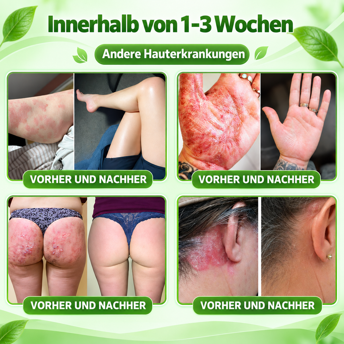 𝐌𝐎𝐏𝐑𝐎® 👩‍⚕️👩‍⚕️ 𝐈𝐋-𝟐𝟑𝐑-𝐀𝐧𝐭𝐚𝐠𝐨𝐧𝐢𝐬𝐭-𝐏𝐞𝐩𝐭𝐢𝐝 + 𝐈𝐧𝐝𝐢𝐫𝐮𝐛𝐢𝐧 𝟏𝟎-𝐈𝐍-𝟏 𝐍𝐚𝐧𝐨-𝐌𝐢𝐤𝐫𝐨𝐧𝐚𝐝𝐞𝐥-𝐏𝐟𝐥𝐚𝐬𝐭𝐞𝐫 (𝐇𝐢𝐥𝐟𝐭 𝐛𝐞𝐢 𝐑ö𝐭𝐮𝐧𝐠𝐞𝐧, 𝐒𝐜𝐡𝐮𝐩𝐩𝐮𝐧𝐠, 𝐓𝐫𝐨𝐜𝐤𝐞𝐧𝐡𝐞𝐢𝐭 & 𝐉𝐮𝐜𝐤𝐫𝐞𝐢𝐳 𝐮𝐧𝐝 𝐮𝐧𝐭𝐞𝐫𝐬𝐭ü𝐭𝐳𝐭 𝐇𝐚𝐮𝐭𝐞𝐫𝐧𝐞𝐮𝐞𝐫𝐮𝐧𝐠 & 𝐇𝐚𝐮𝐭𝐛𝐚𝐫𝐫𝐢𝐞𝐫𝐞.)
