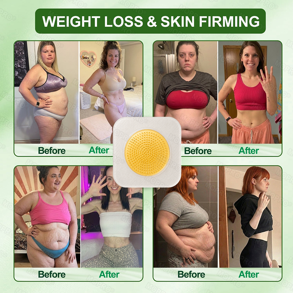 🔥 Only 10 packs left! Extra 30% off!   𝐌𝗢𝑷𝙍𝙊® 𝐋𝐲𝐦𝐩𝐡𝐚𝐭𝐢𝐜 𝐃𝐫𝐚𝐢𝐧𝐚𝐠𝐞 𝐒𝐥𝐢𝐦𝐦𝐢𝐧𝐠 𝐍𝐚𝐧𝐨-𝐌𝐢𝐜𝐫𝐨𝐧𝐞𝐞𝐝𝐥𝐞 𝐏𝐚𝐭𝐜𝐡: 𝐔𝐥𝐭𝐫𝐚-𝐏𝐨𝐭𝐞𝐧𝐭 𝟓× 𝐅𝐨𝐫𝐦𝐮𝐥𝐚 𝐰𝐢𝐭𝐡 𝐋𝐢𝐩𝐨𝐥𝐲𝐭𝐢𝐜 𝐏𝐞𝐩𝐭𝐢𝐝𝐞 𝐂𝐨𝐦𝐩𝐥𝐞𝐱 — 𝐒𝐮𝐩𝐩𝐨𝐫𝐭𝐬 𝐖𝐞𝐢𝐠𝐡𝐭 𝐋𝐨𝐬𝐬 & 𝐋𝐲𝐦𝐩𝐡𝐚𝐭𝐢𝐜 𝐅𝐥𝐨𝐰 — 𝐏𝐥𝐮𝐬 𝐉𝐨𝐢𝐧𝐭 𝐑𝐞𝐥𝐢𝐞𝐟, 𝐁𝐞𝐭𝐭𝐞𝐫 𝐒𝐥𝐞𝐞𝐩 & 𝐌𝐞𝐧𝐭𝐚𝐥 𝐂𝐥𝐚𝐫𝐢𝐭𝐲💪